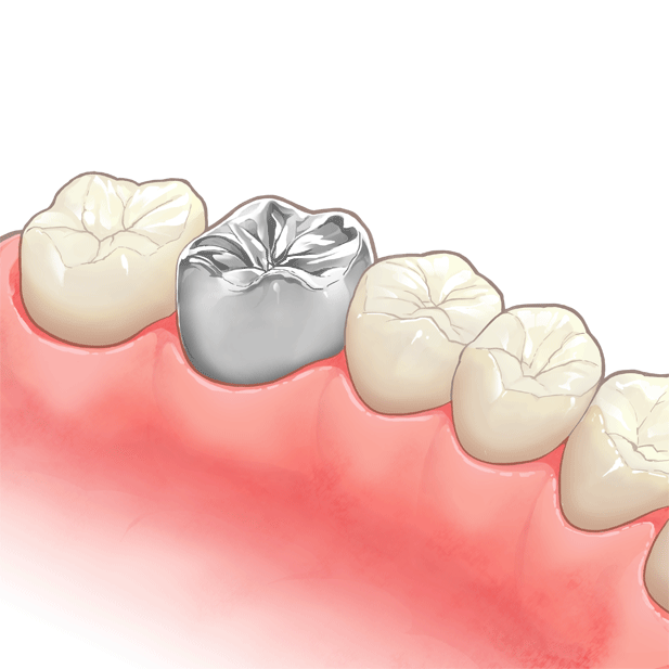 詰め物（インレー）