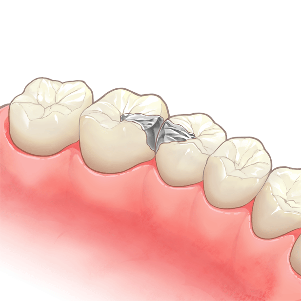 被せ物（クラウン）